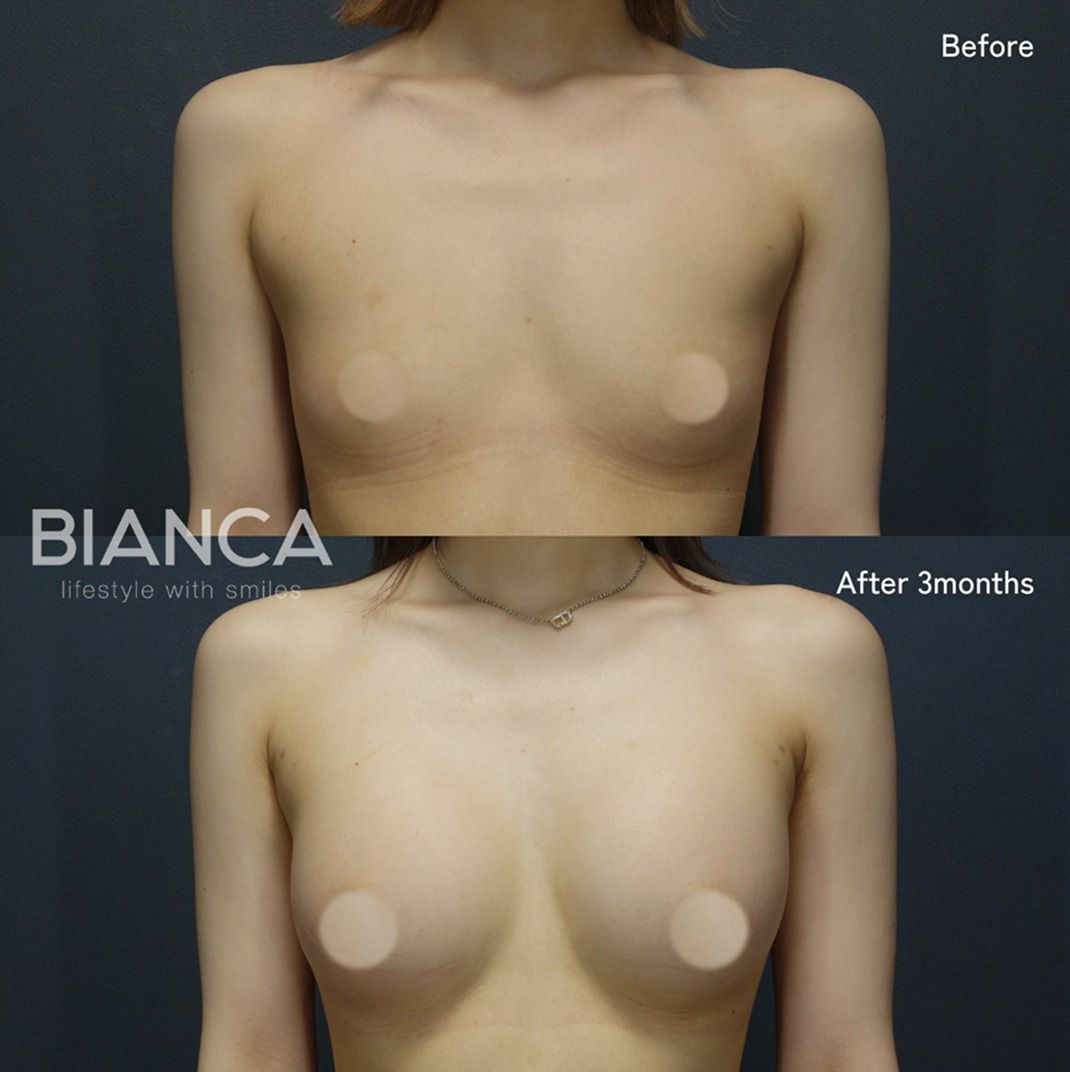 Before and 3 months after hybrid breast augmentation.
