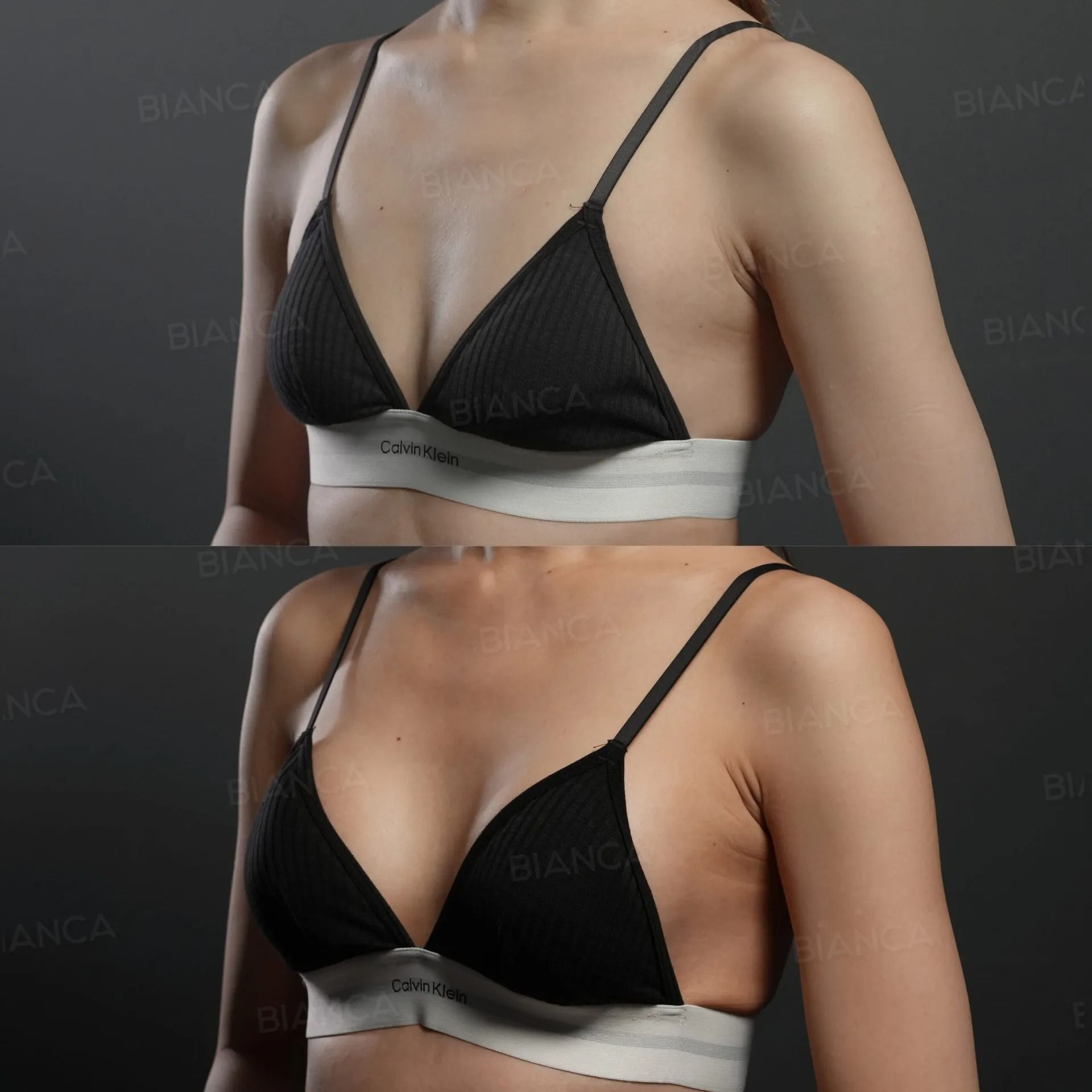 Before and 1 week after Preservé™ Demi 195 cc silicone breast augmentation.
