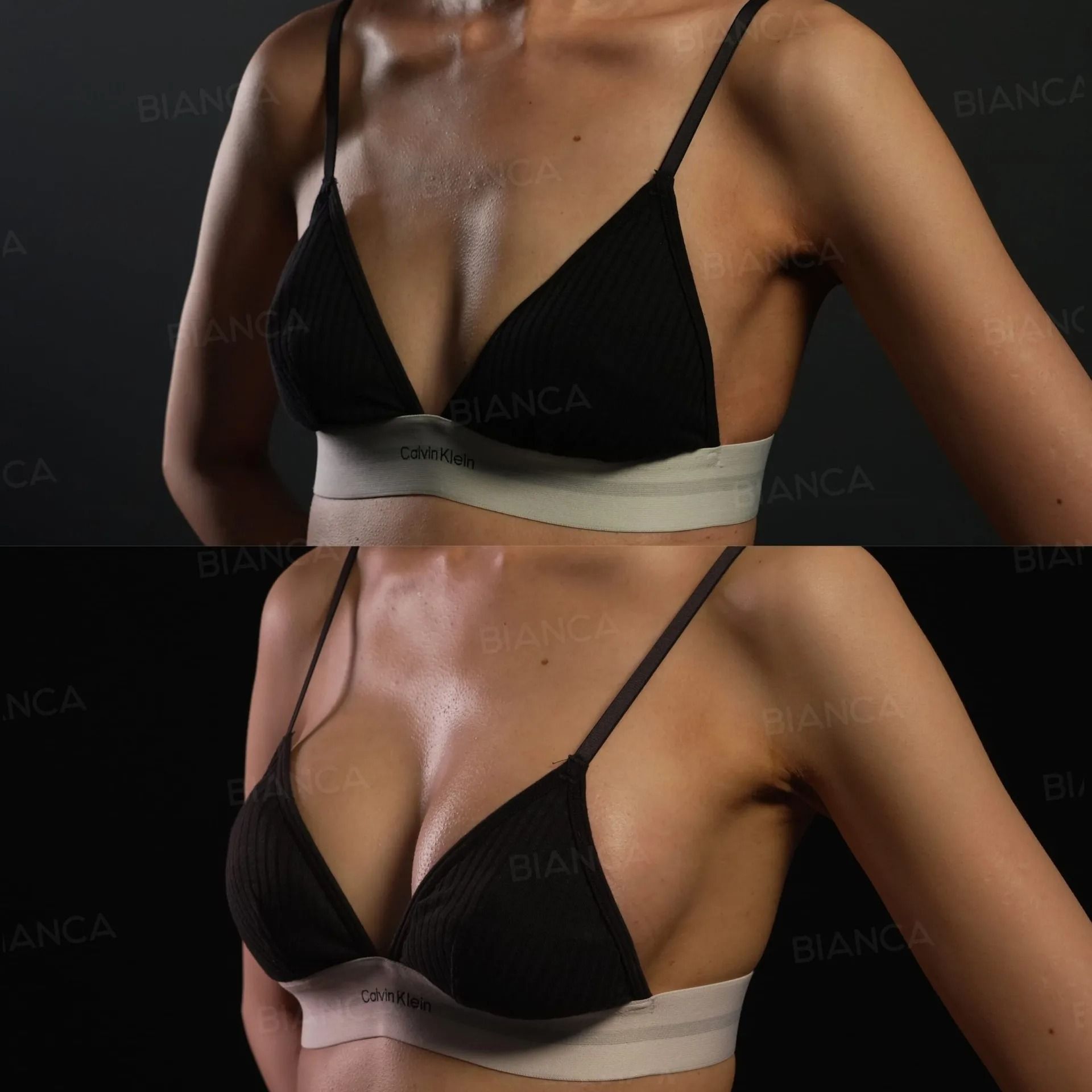 Before and 2 weeks after Preservé™ Mini 235 cc silicone breast augmentation.
