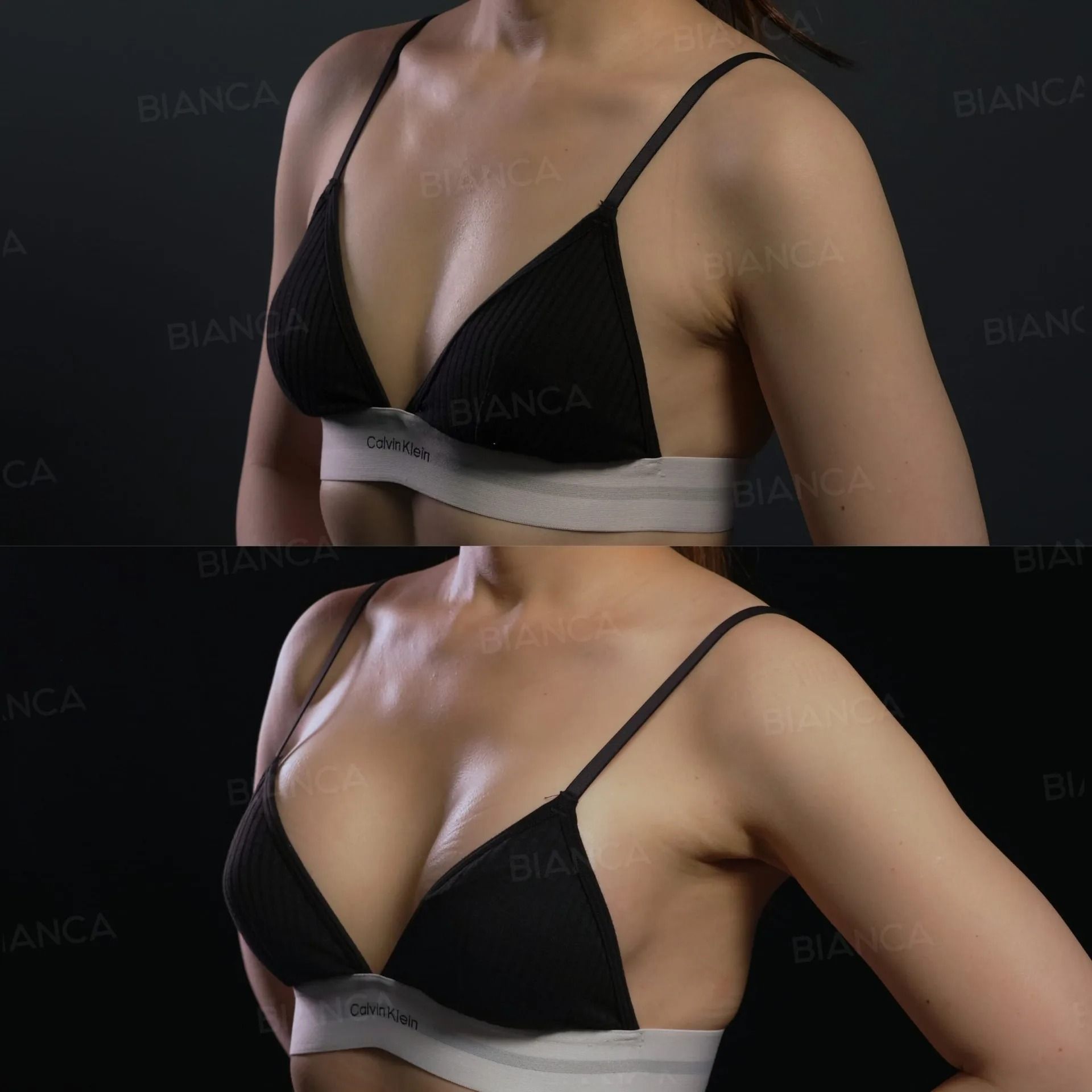 Before and 2 weeks after Preservé™ Mini 200 cc silicone breast augmentation.