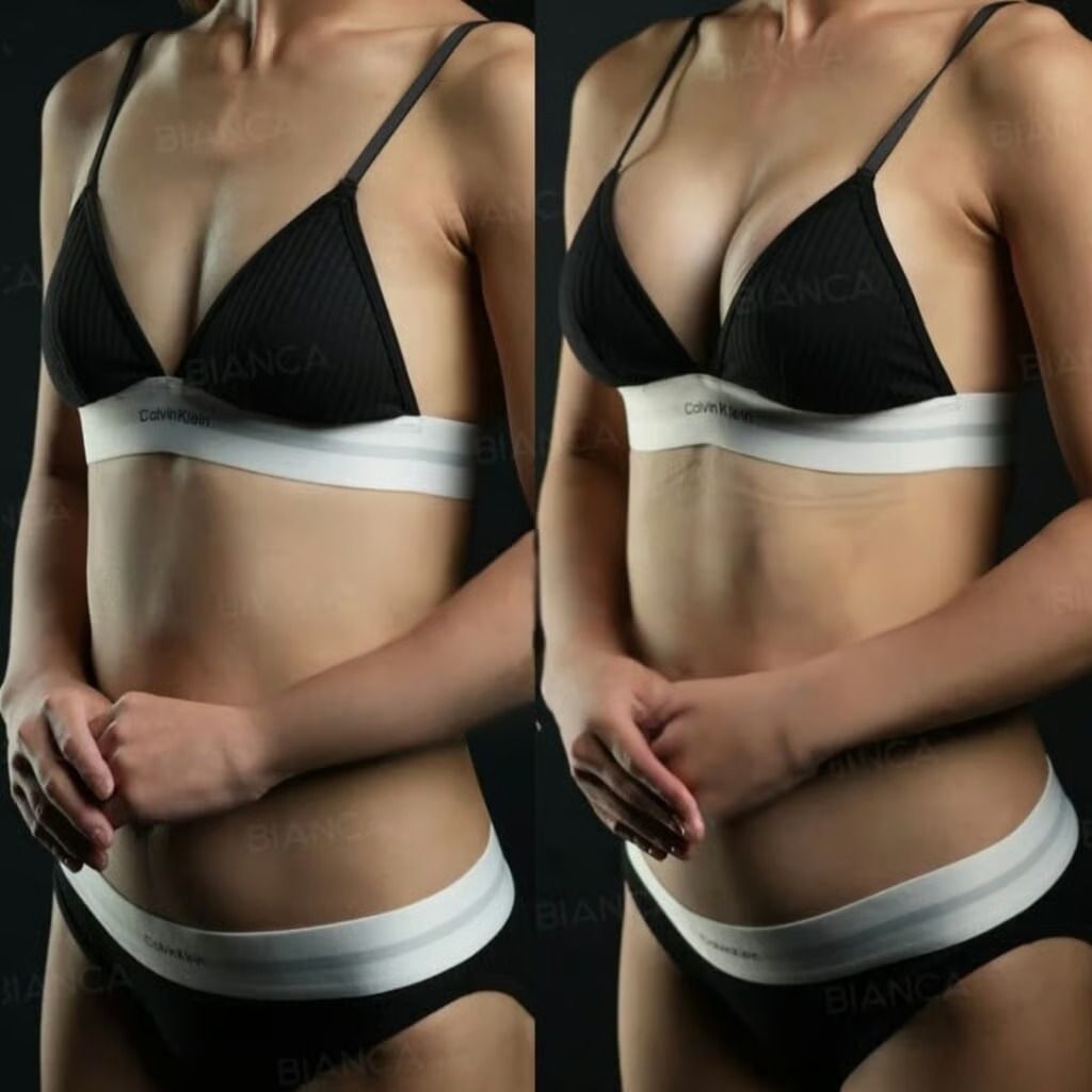 Before and 3 days after Preservé™ silicone breast augmentation.
