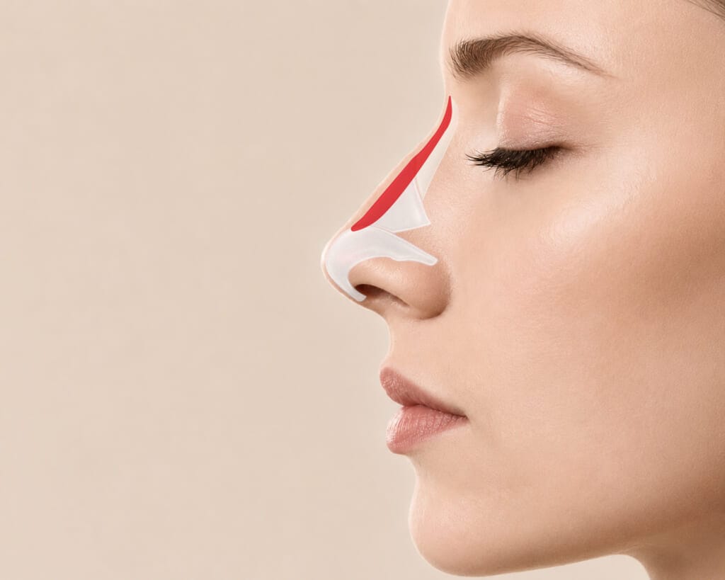 Side profile medical diagram of nasal bridge augmentation showing implant or autologous tissue placement for low bridge enhancement.