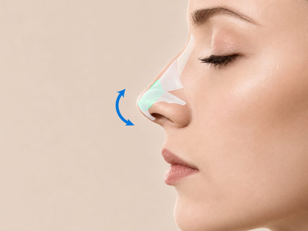 Side profile medical diagram of septal extension graft surgery showing cartilage placement to reposition and elevate the nasal tip.
