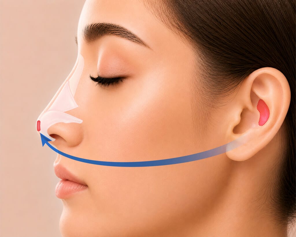 Side profile medical diagram showing ear cartilage harvesting and autologous grafting to the nasal tip for natural tip elevation.