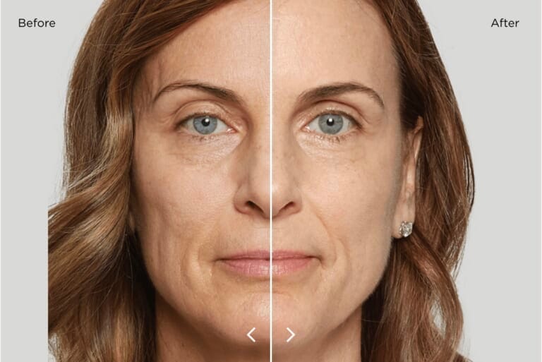 Sculptra Under Eyes at BIANCA CLINIC: A Simple Guide to Natural Rejuvenation in Tokyo