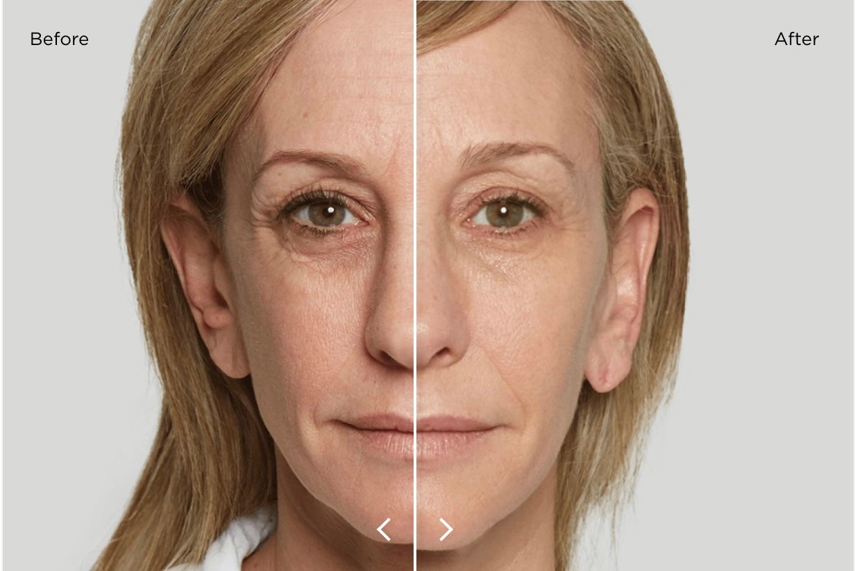 Sculptra Results: Natural Volume That Improves Gradually Over Time in Tokyo