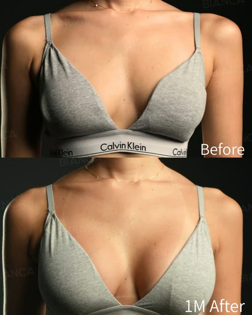 Before and 1 month after silicone breast augmentation.