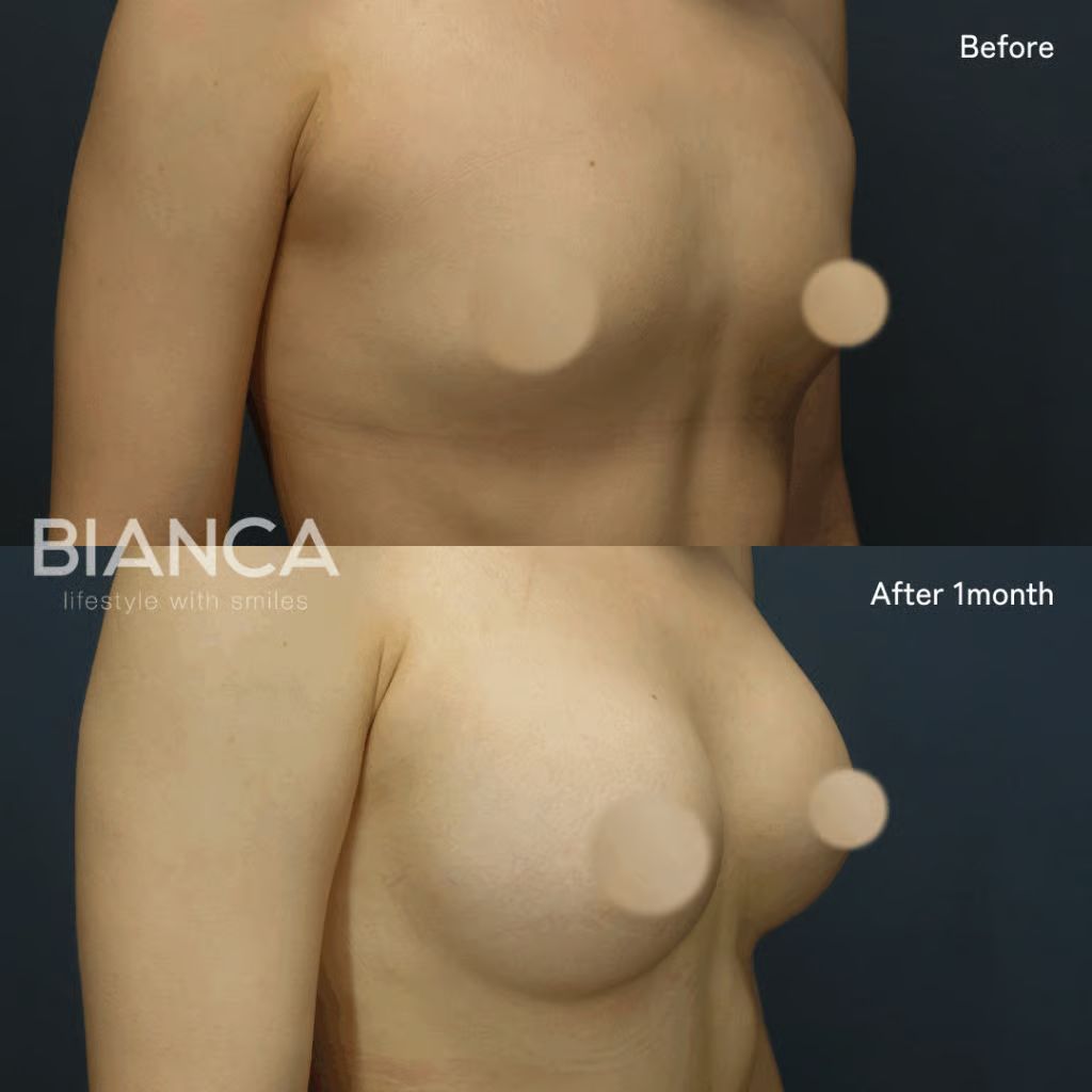 Before and 1 month after silicone breast augmentation.