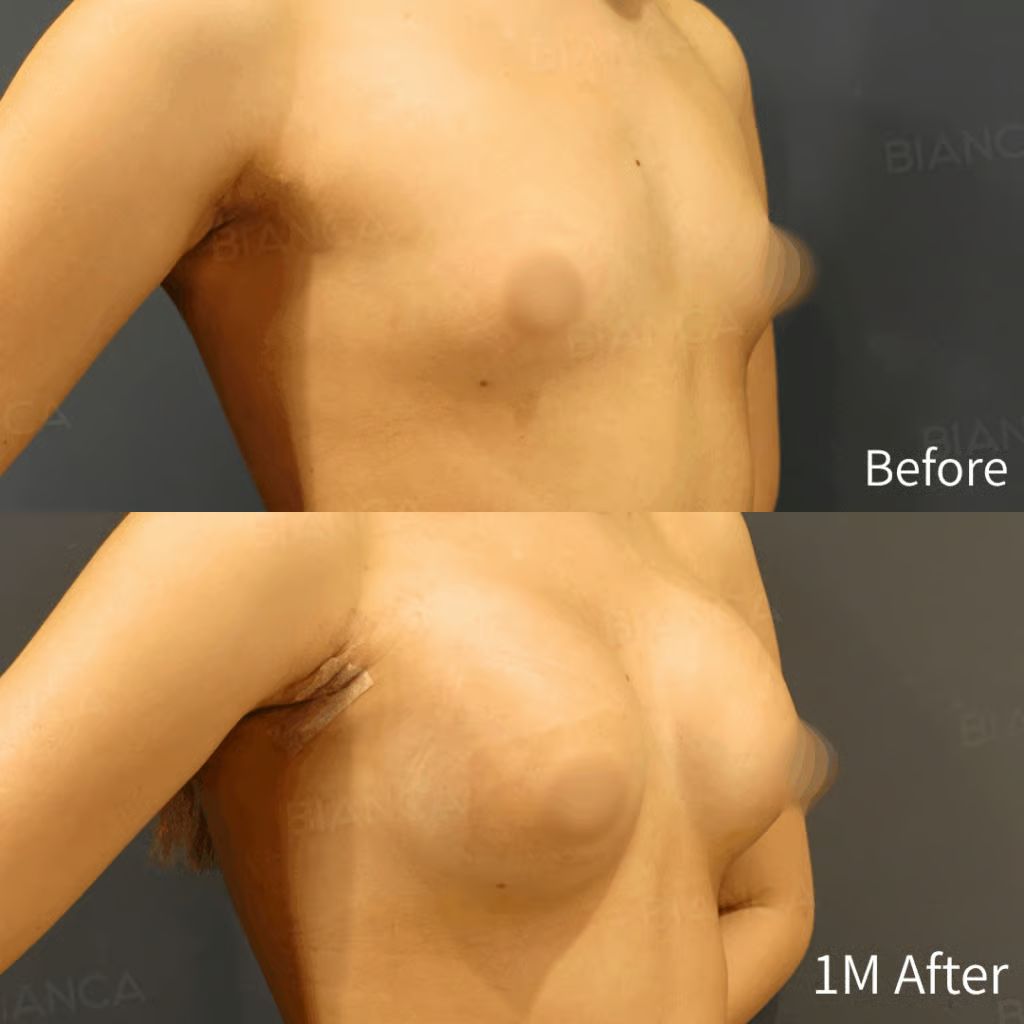 Before and 3 months after silicone breast augmentation.