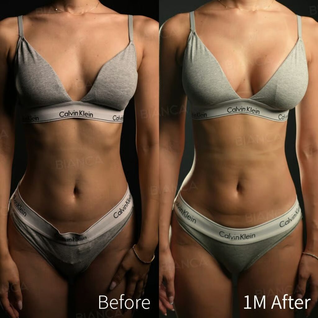 Before and 1 month after silicone breast augmentation.