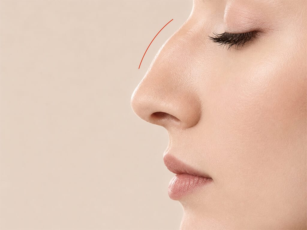 Side profile of a woman's nose with a red line indicating a bump on the bridge for hump reduction assessment.