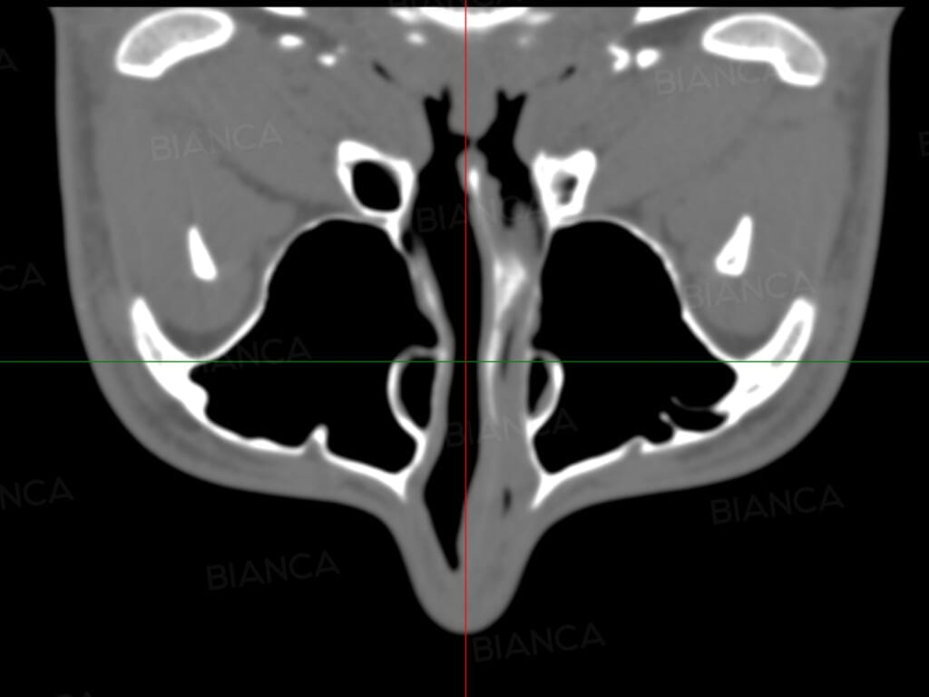 CT scan showing nasal septum deviation for functional and cosmetic rhinoplasty assessment.