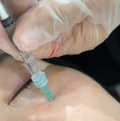 Numbing Cream (Optional)