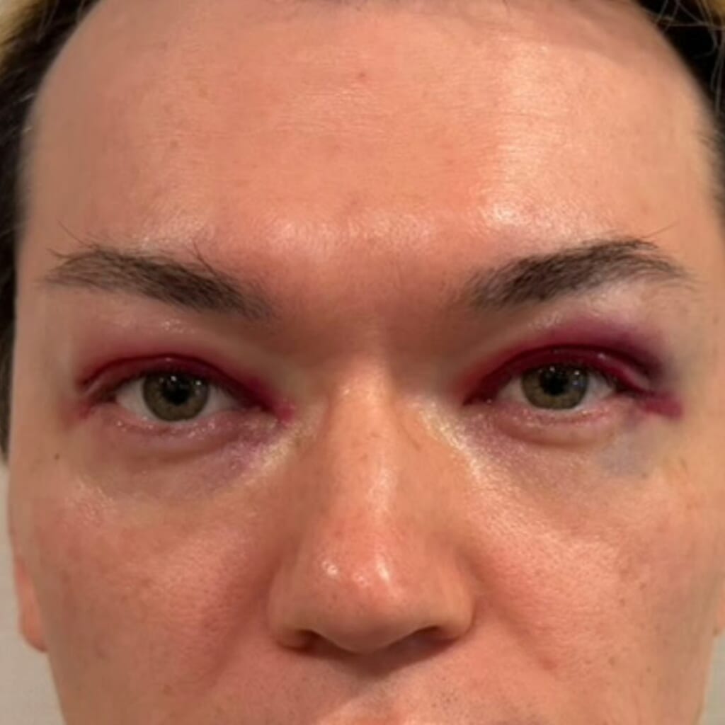 UPPER EYELID SAGGING REMOVAL-day1