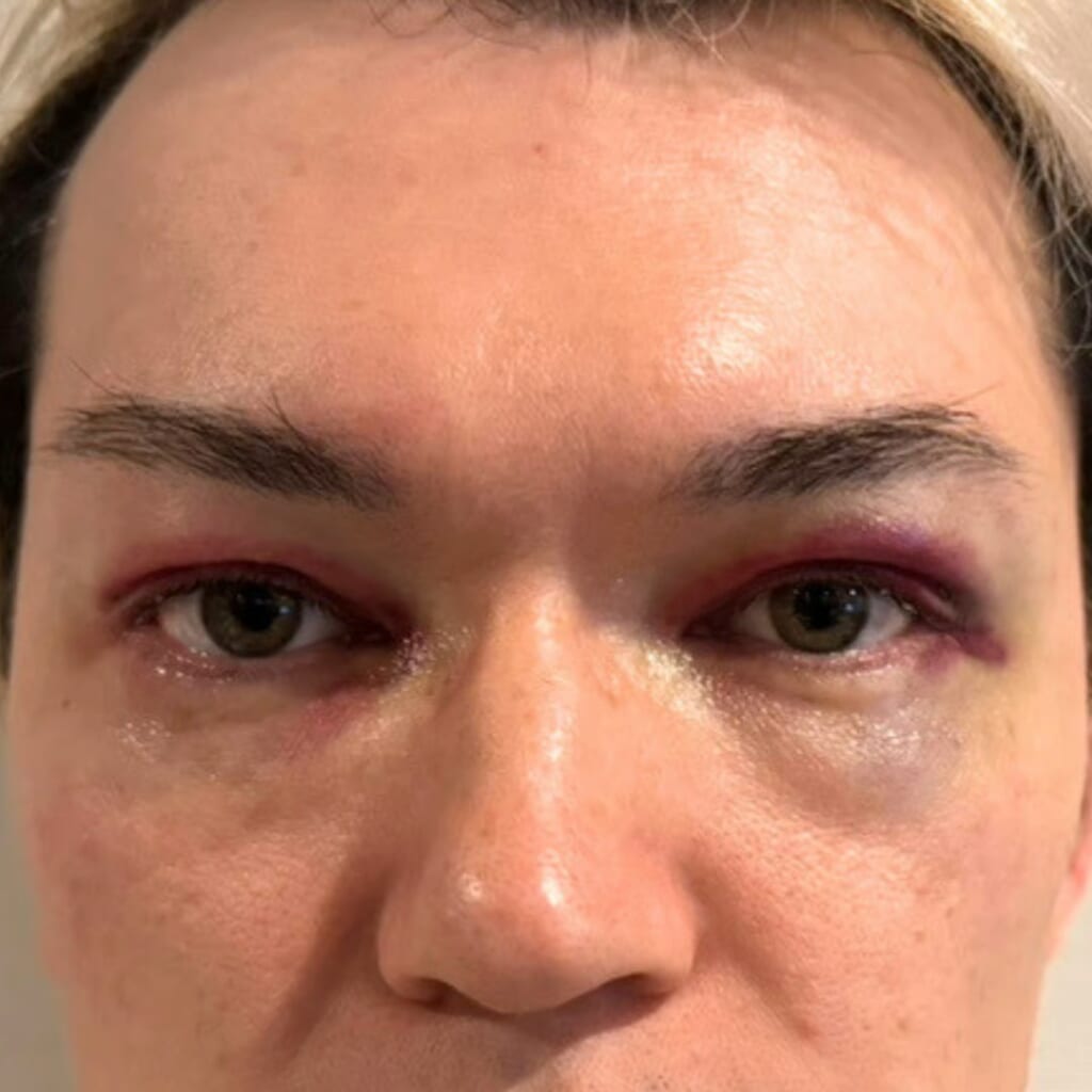 UPPER EYELID SAGGING REMOVAL-day2