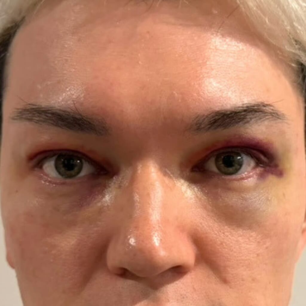 UPPER EYELID SAGGING REMOVAL-day3