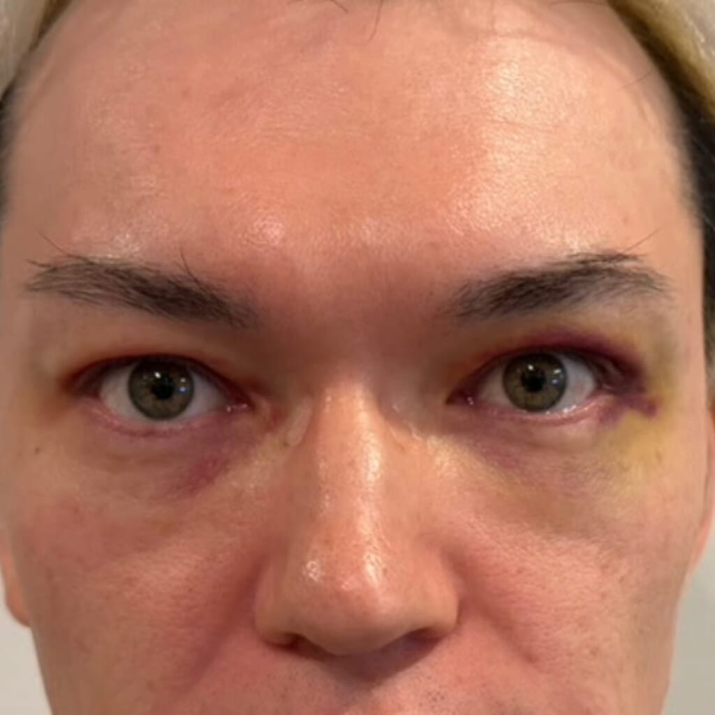 UPPER EYELID SAGGING REMOVAL-day4