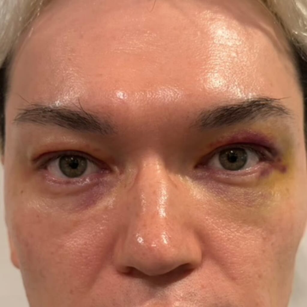 UPPER EYELID SAGGING REMOVAL-day5