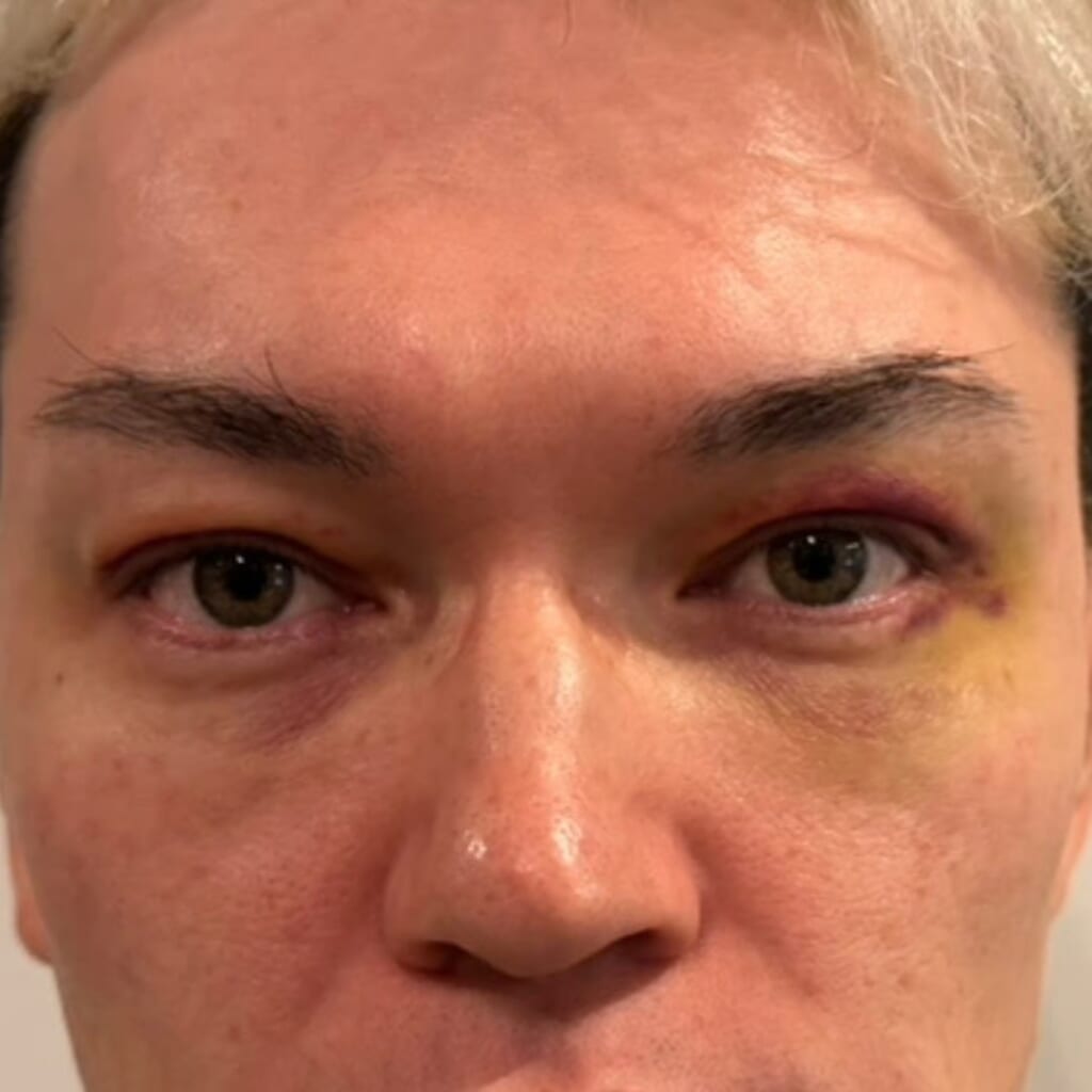UPPER EYELID SAGGING REMOVAL-day6