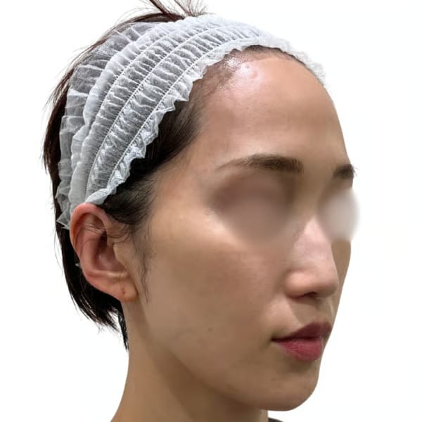 advatex-Immediately After Treatment