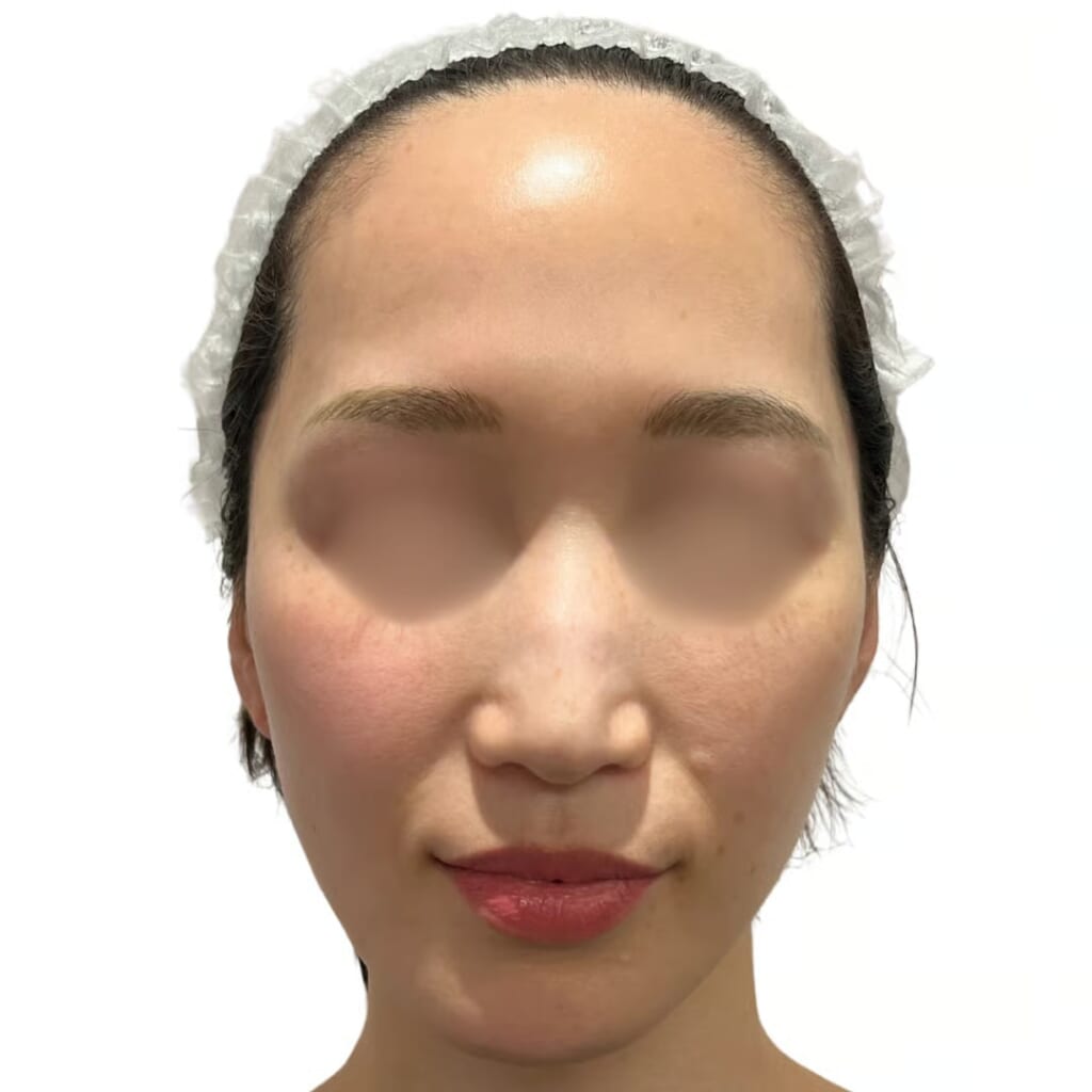alma-primex-Immediately After Treatment