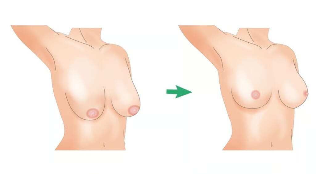 Breast ptosis and post-lift shape comparison diagram