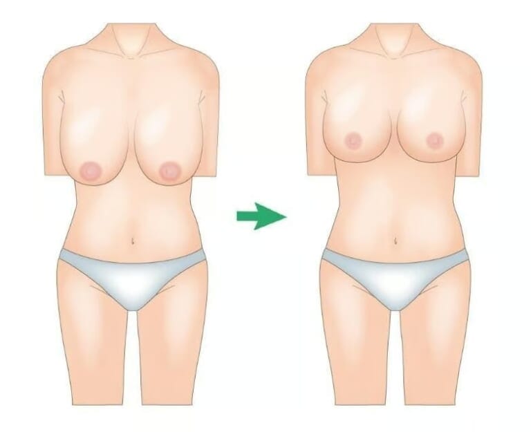Breast reduction illustration