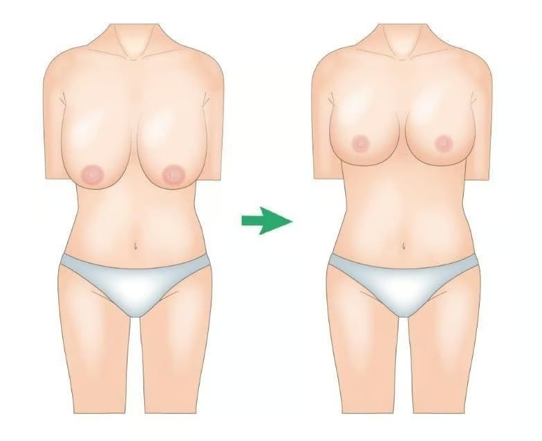 Breast reduction illustration