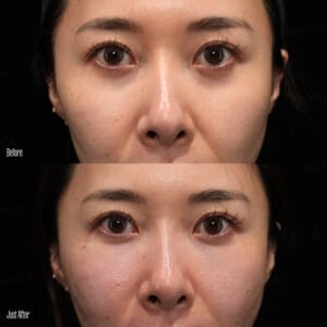 ezGEL (PRF) before and after — natural under-eye and midface volume restoration with autologous blood-derived filler at BIANCA CLINIC Tokyo