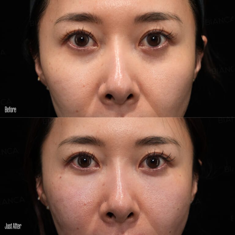 ezGEL (PRF) before and after — natural under-eye and midface volume restoration with autologous blood-derived filler at BIANCA CLINIC Tokyo