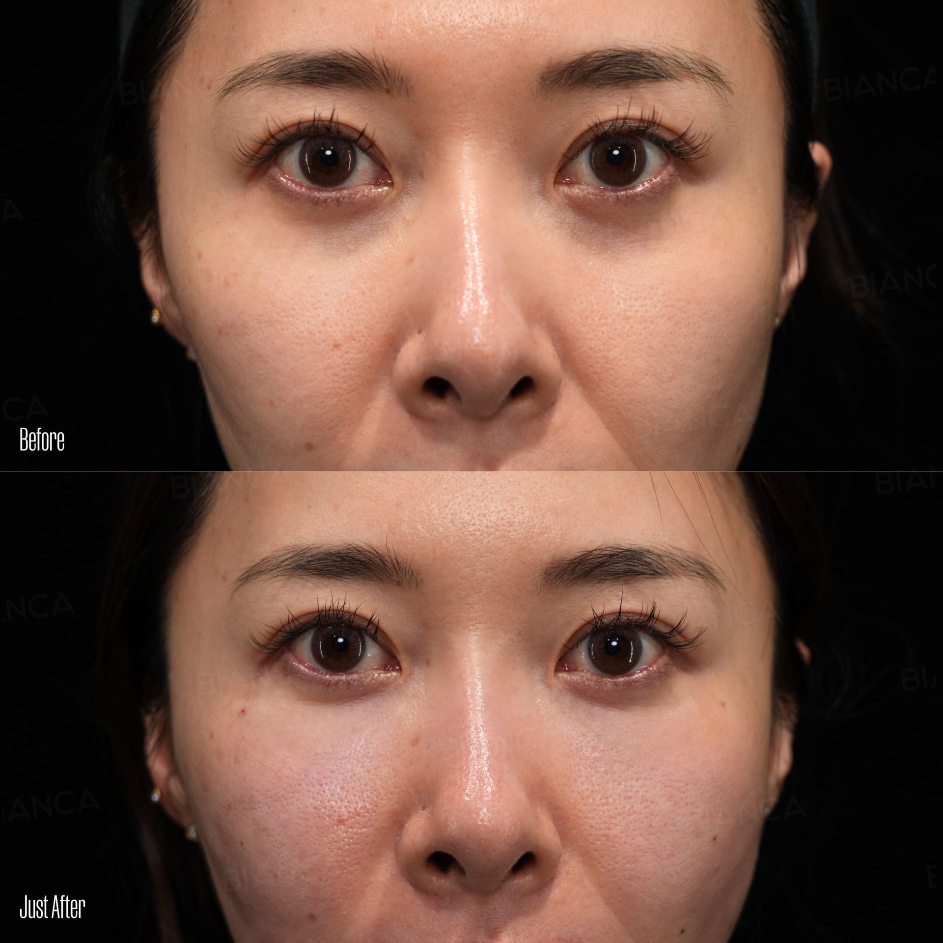 ezGEL (PRF) before and after — natural under-eye and midface volume restoration with autologous blood-derived filler at BIANCA CLINIC Tokyo