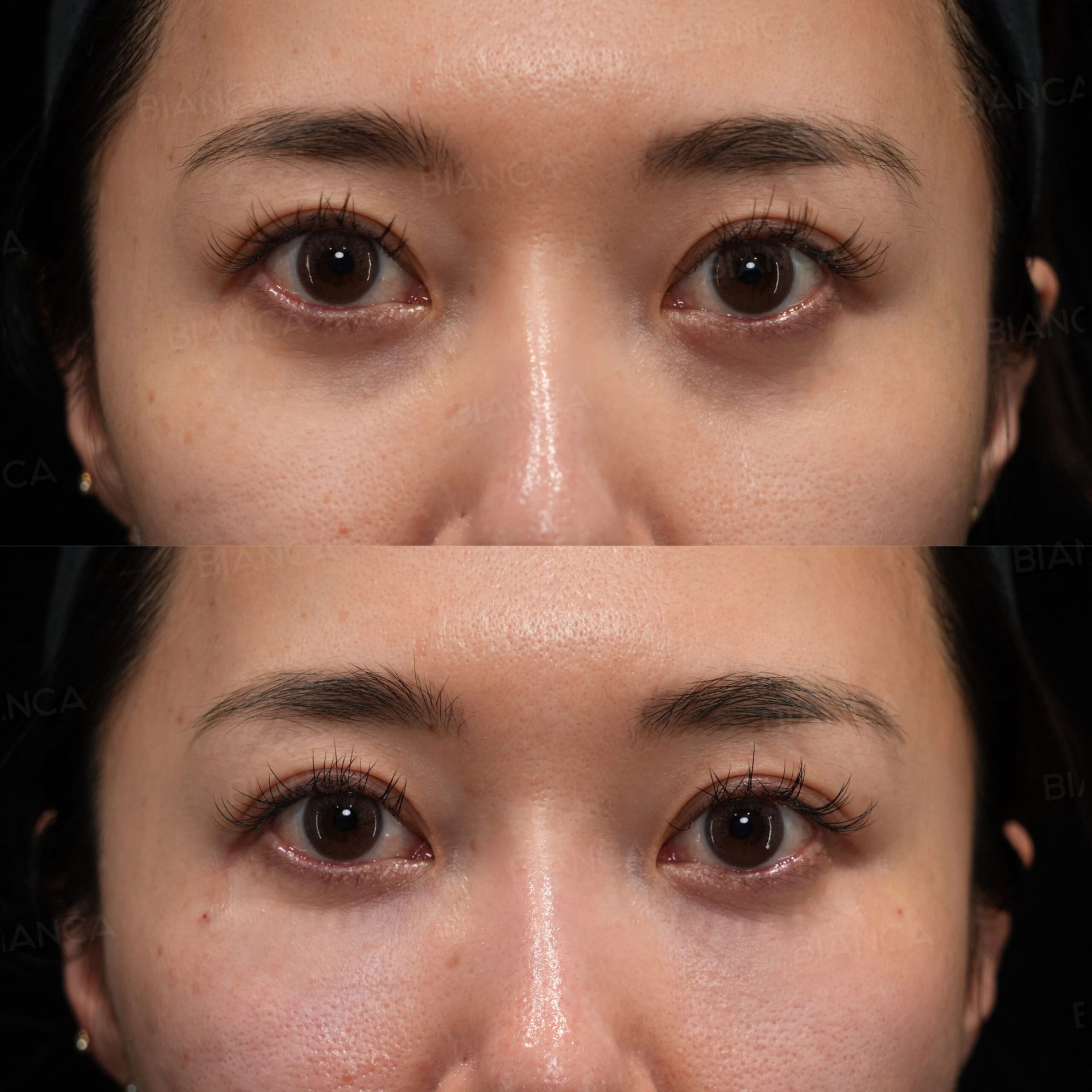Front view before and immediately after ezGEL (PRF) injection for under-eye hollows at BIANCA CLINIC Tokyo (top: before, bottom: immediately after)