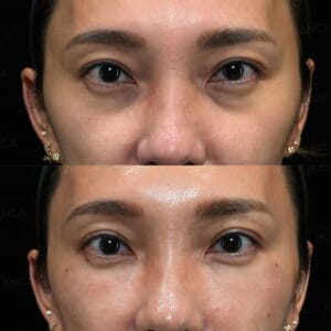 Front view before and immediately after ezGEL (PRF) injection for dark circles and under-eye hollows at BIANCA CLINIC Tokyo (top: before, bottom: immediately after)