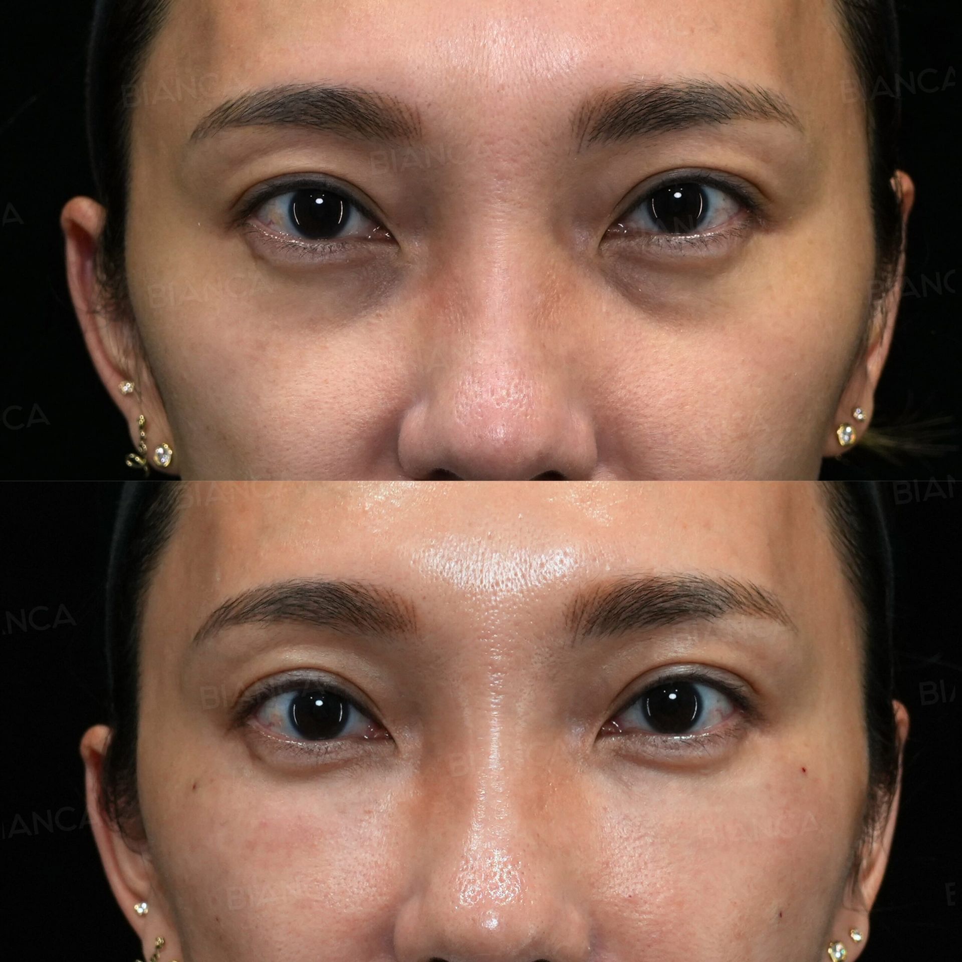 Front view before and immediately after ezGEL (PRF) injection for dark circles and under-eye hollows at BIANCA CLINIC Tokyo (top: before, bottom: immediately after)