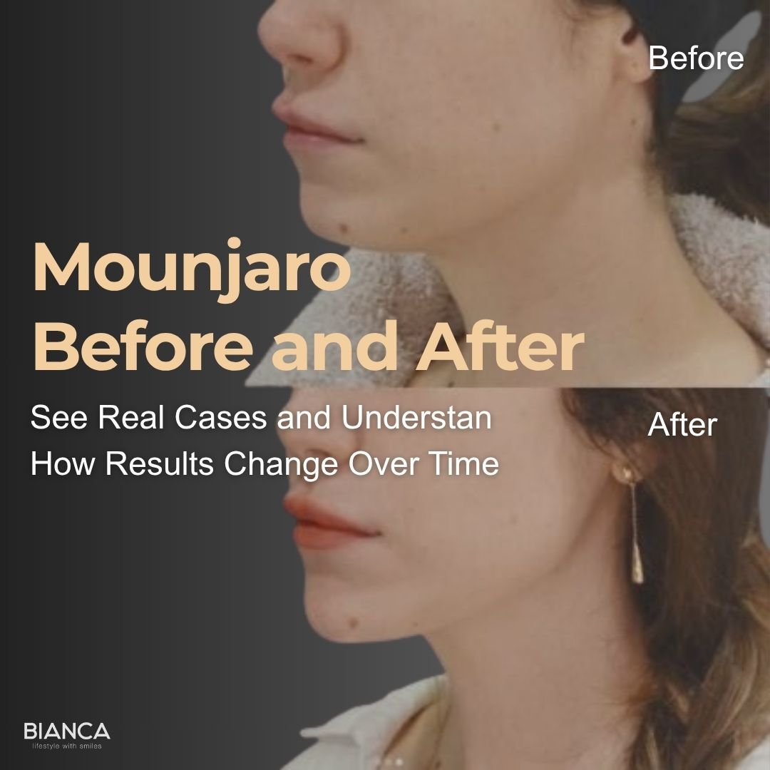 Mounjaro Before and After profile view showing facial contour changes over time, featured by BIANCA.