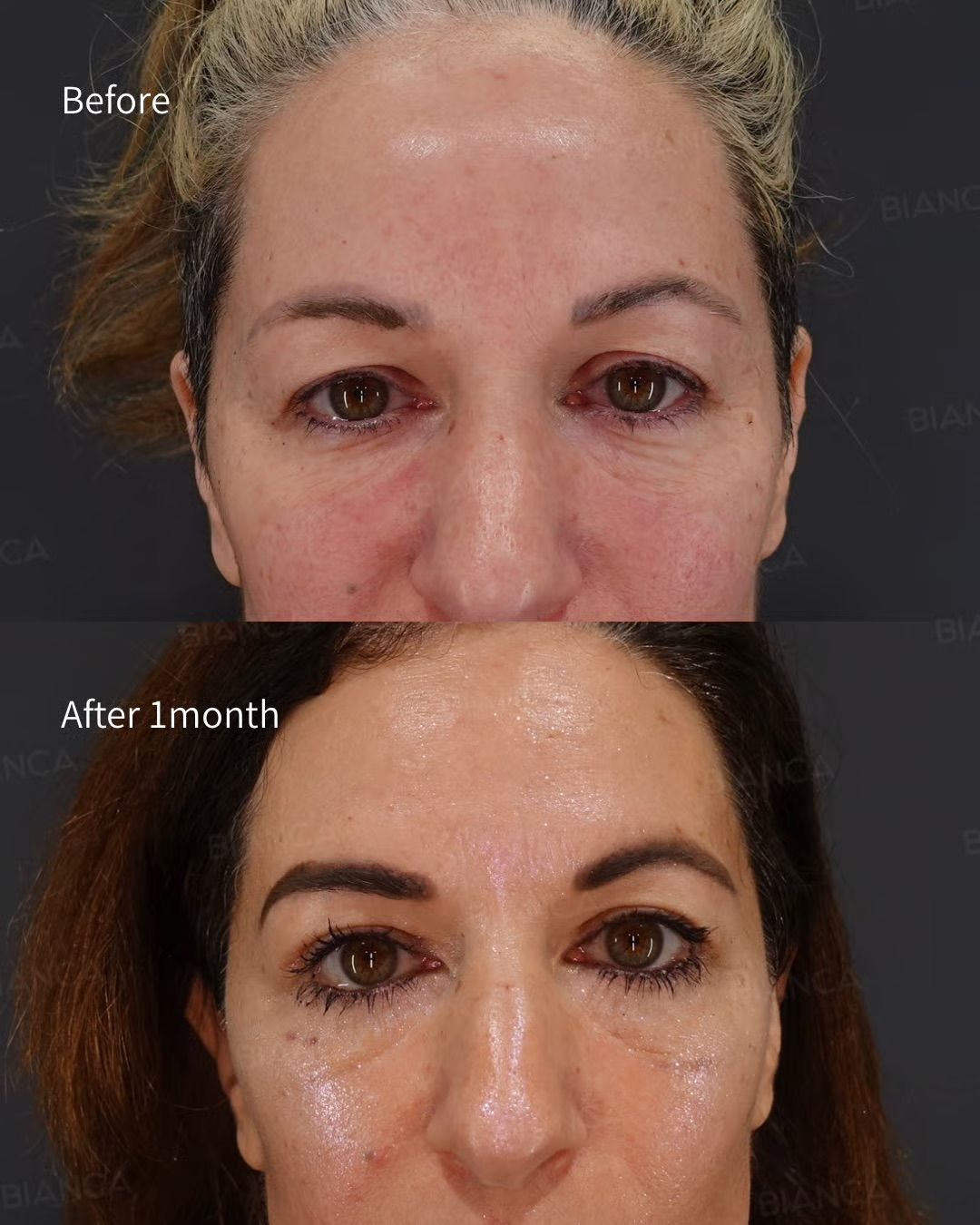 Plastic Surgery Before and After in Tokyo: Natural Results & Reliable Treatment