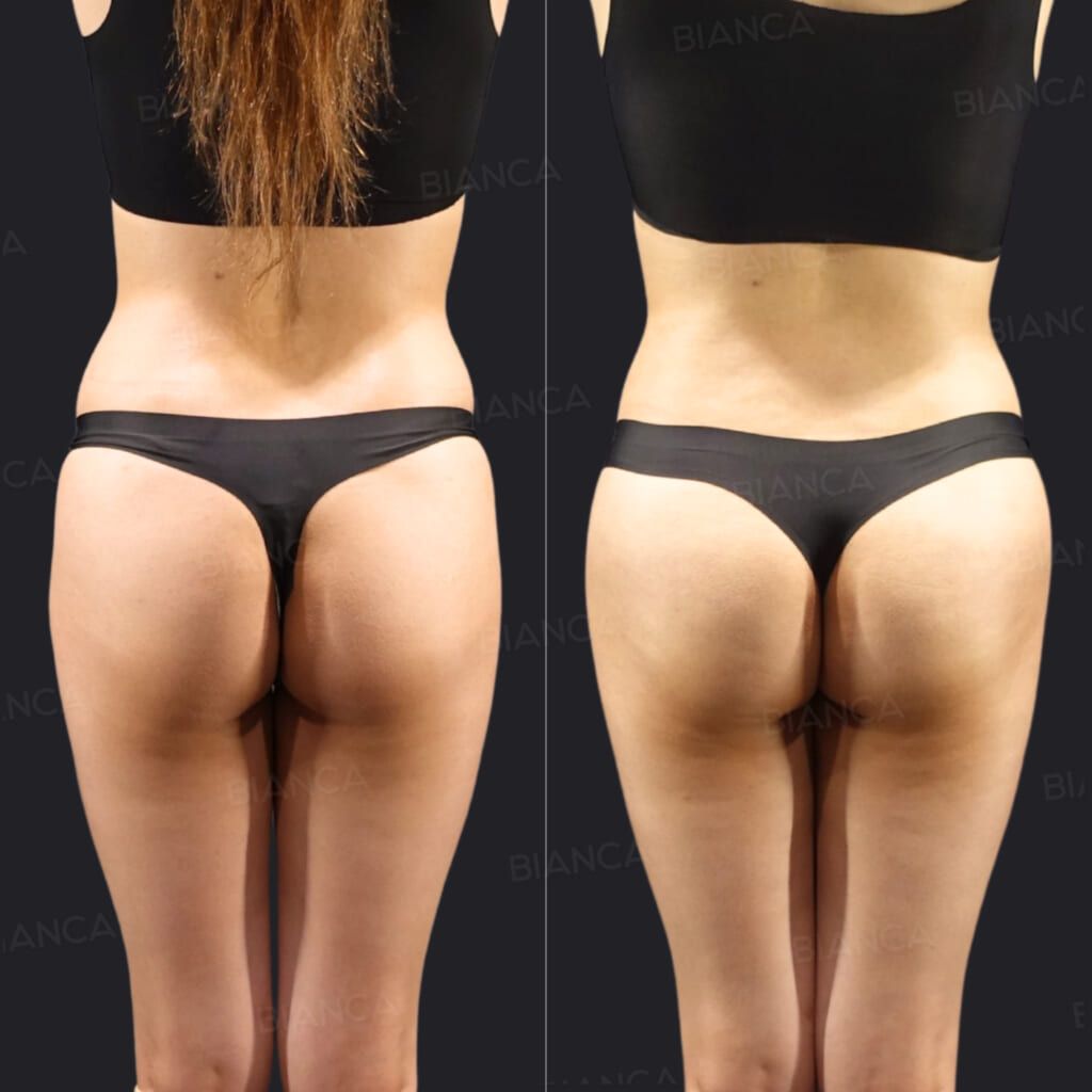 VASER 4D abdominal etching before and after Brazilian Butt Lift fat transfer, showing the buttocks and lower back at 3 months