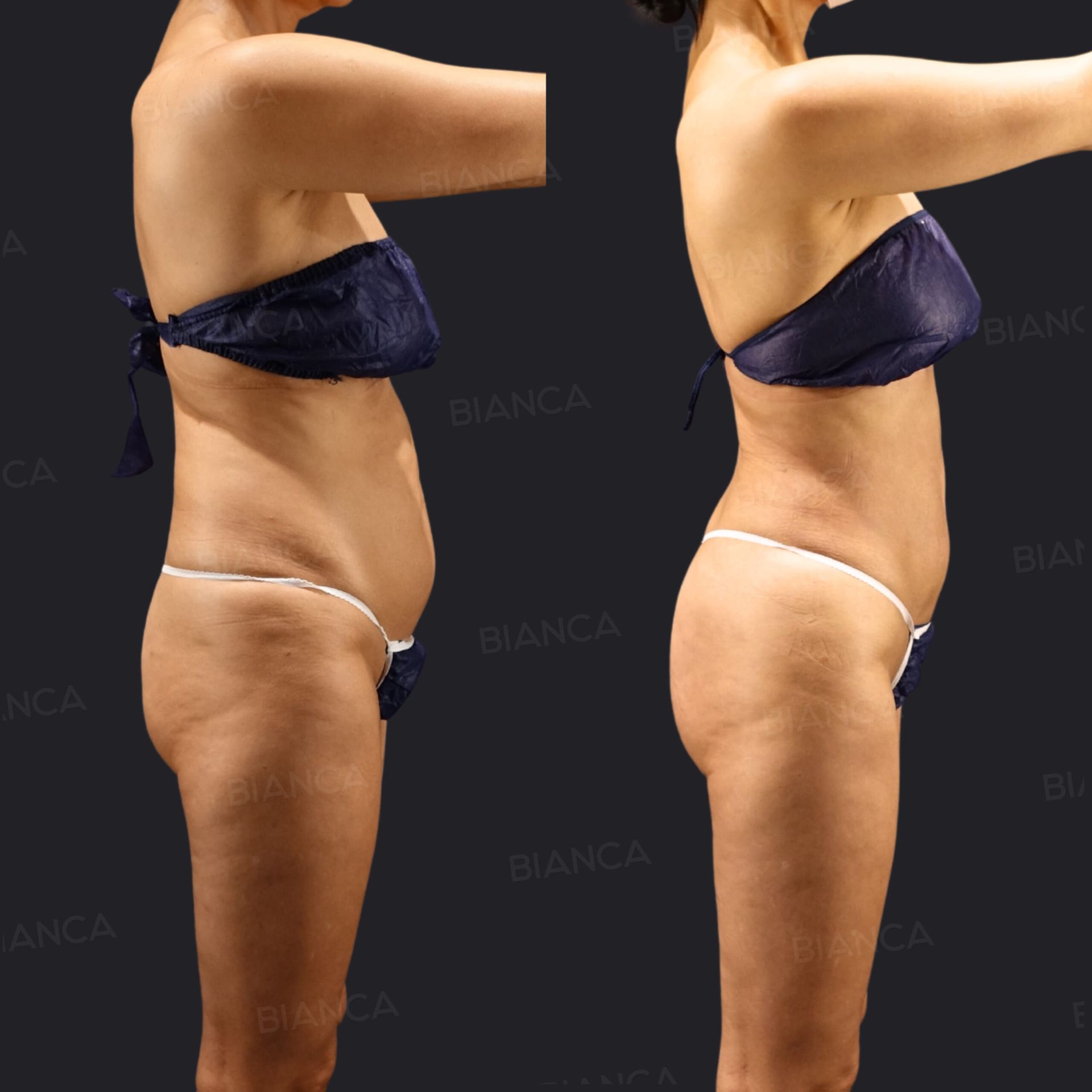 Brazilian butt lift (BBL) before and after fat transfer with VASER liposuction of the waist and love handles, side view of the torso and hips at 3 months