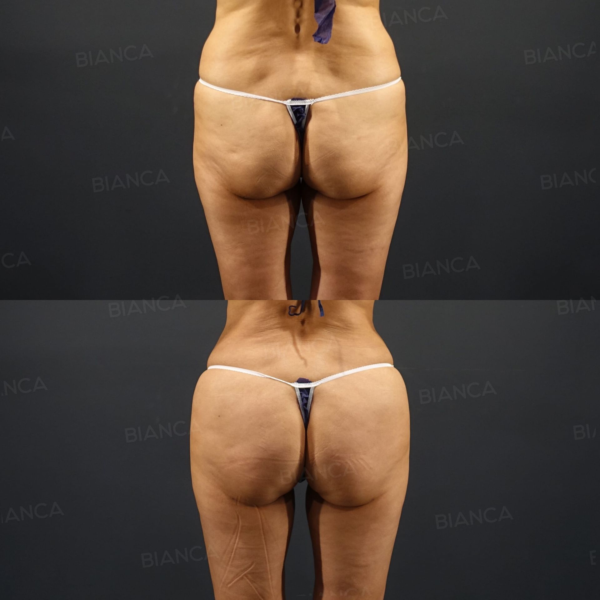 Brazilian butt lift (BBL) before and after fat transfer to the buttocks and hips with VASER liposuction of the waist and love handles at 3 months