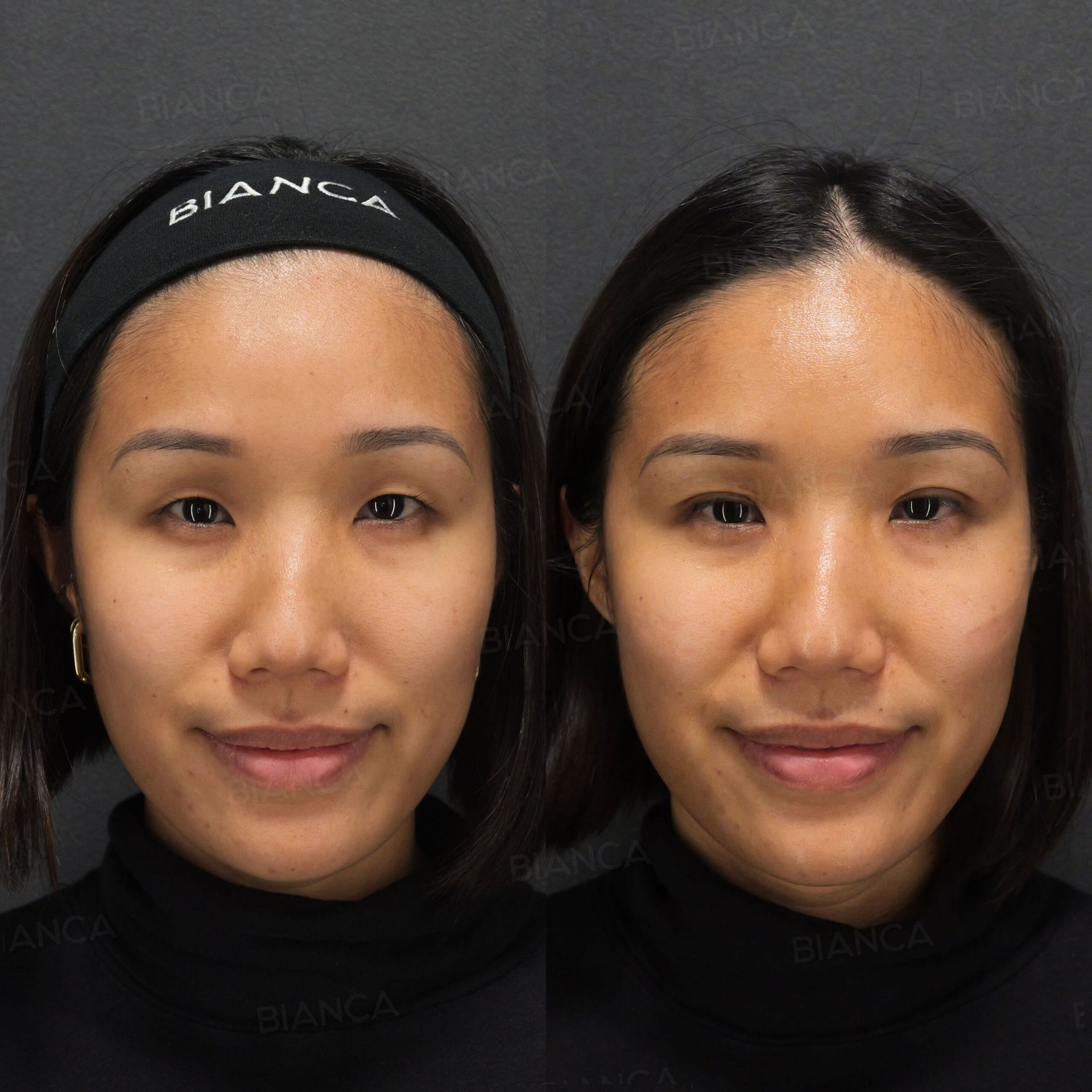 Double eyelid surgery before and after the B TWICE suture method forming the crease without an incision, front view, immediately after treatment