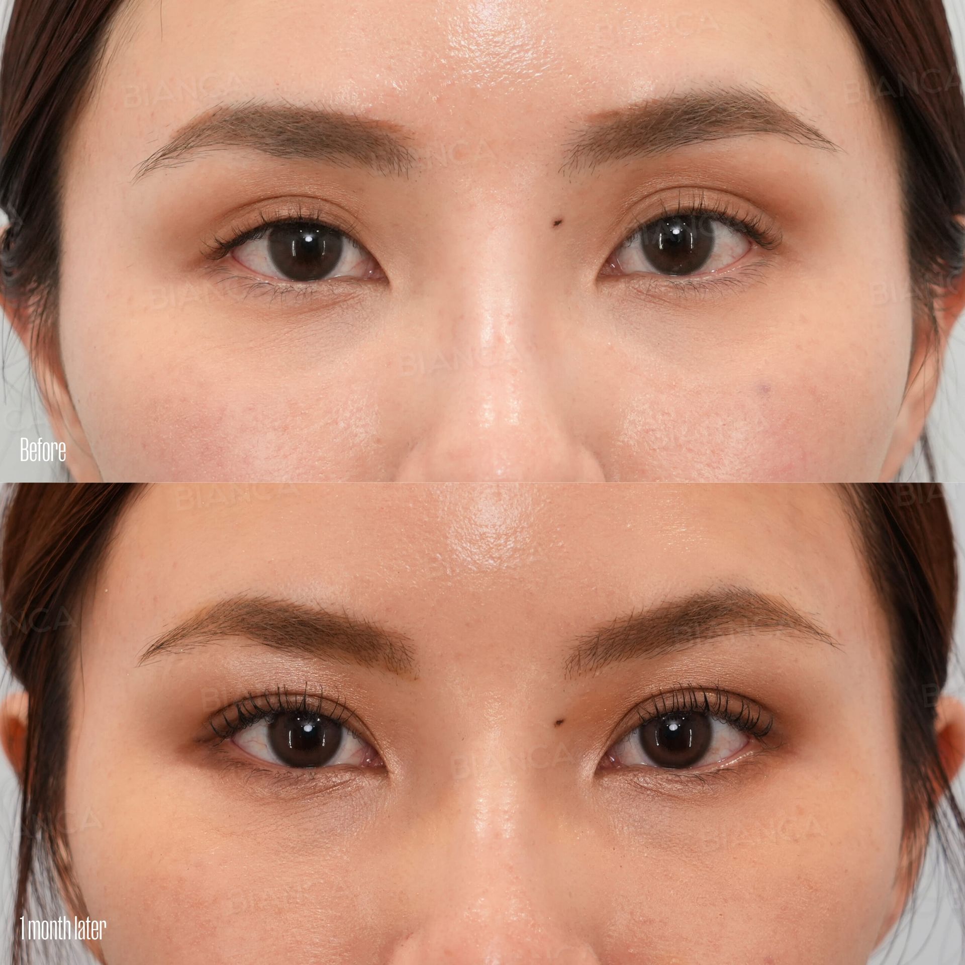 Double eyelid surgery before and after the natural adhesion method, close-up of the eyes in front view with the crease settled at 1 month