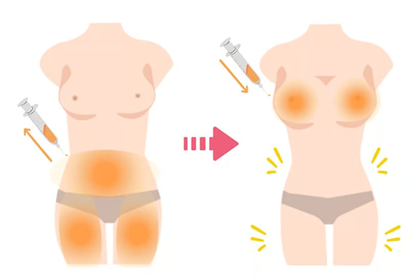 Before-and-after diagram of fat grafting breast augmentation using purified fat