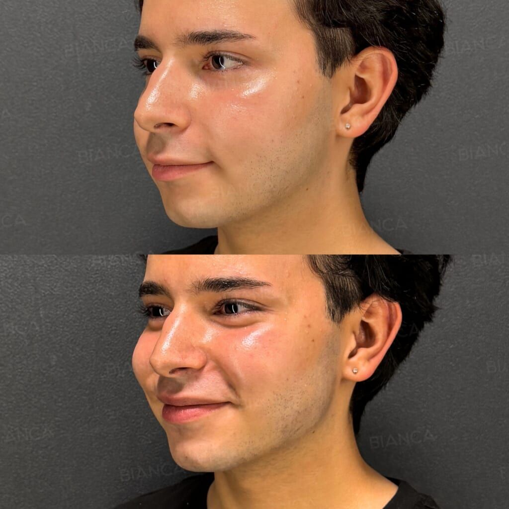 Hyaluronic acid filler before and after contouring along the chin and jawline, three-quarter view, immediately after treatment