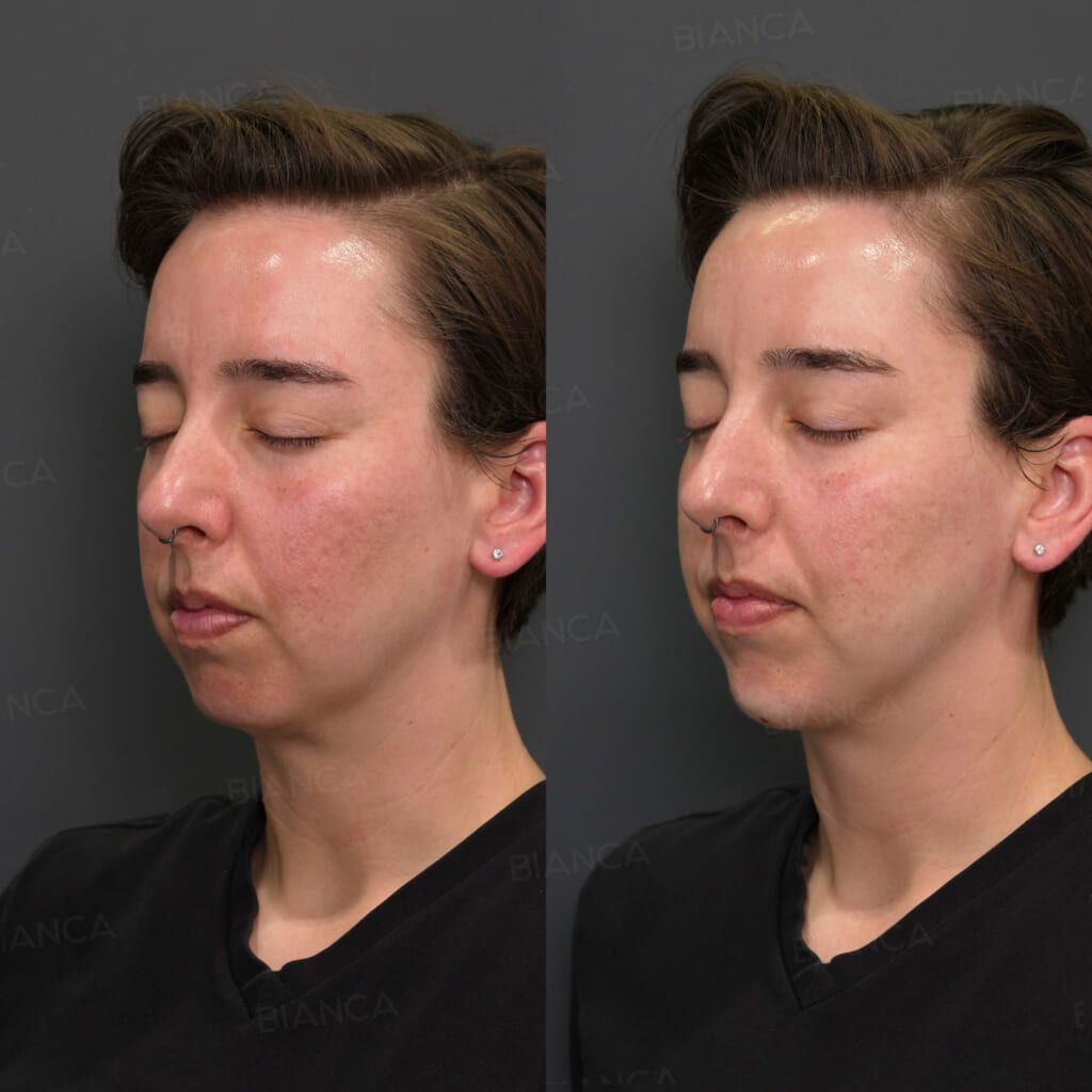 Hyaluronic acid chin filler before and after augmentation with Restylane Lyft, three-quarter view, immediately after treatment