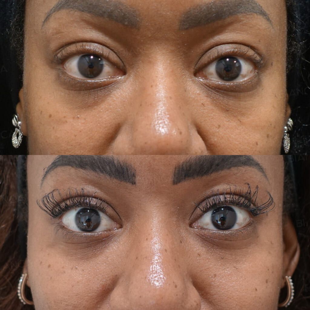 Hyaluronic acid filler before and after NEAUVIA injection, front view of the eye area and midcheek groove, immediately after treatment