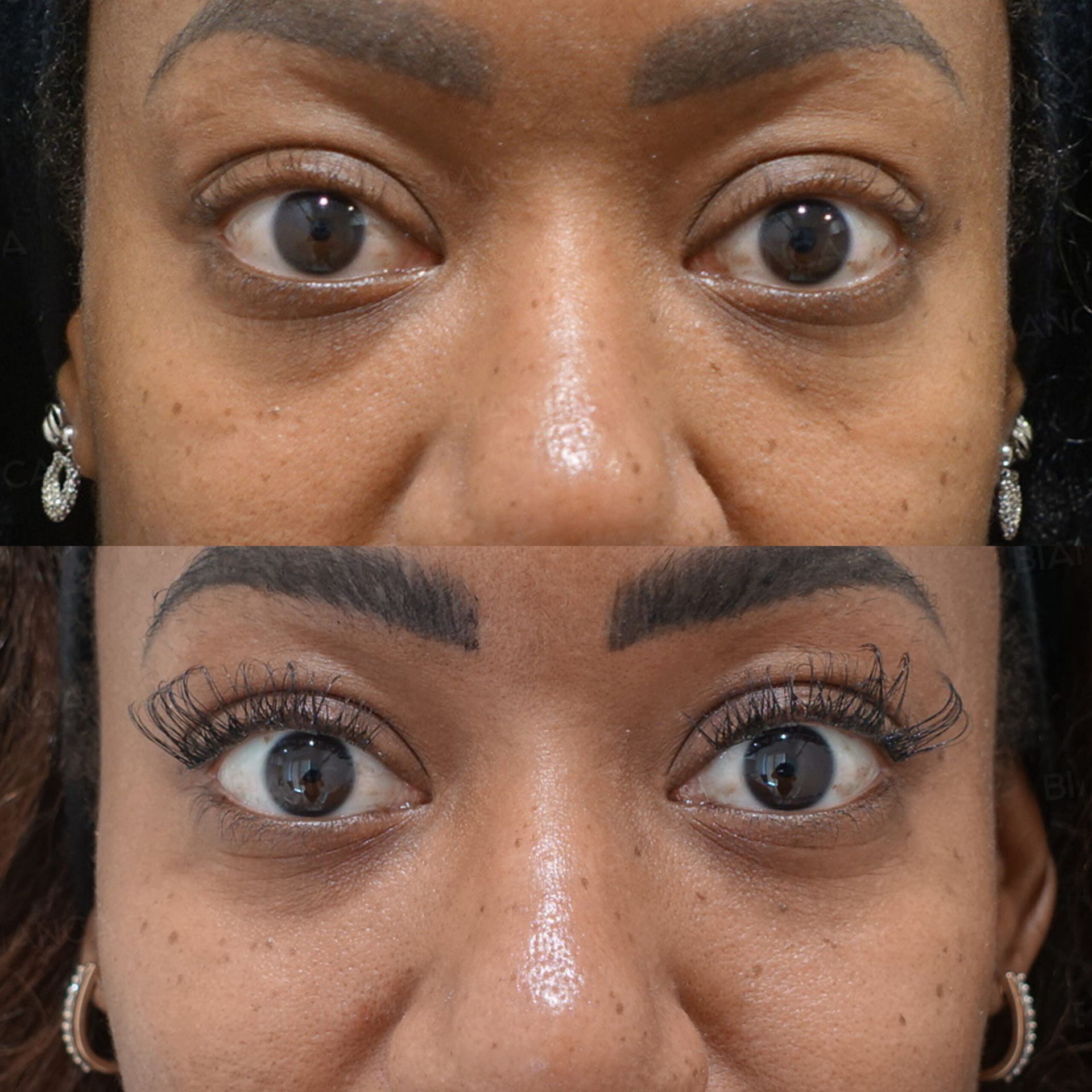 Hyaluronic acid filler before and after NEAUVIA injection, front view of the eye area and midcheek groove, immediately after treatment