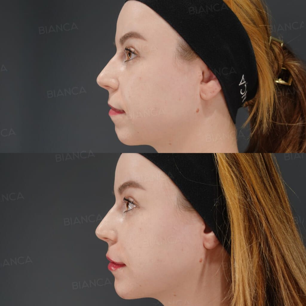 Hyaluronic acid filler before and after injection to the nose, nasolabial folds, alar base and chin, three-quarter view immediately after treatment