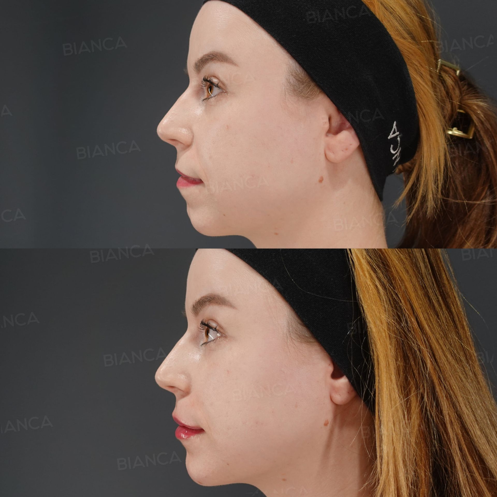 Hyaluronic acid filler before and after injection to the nose, nasolabial folds, alar base and chin, three-quarter view immediately after treatment