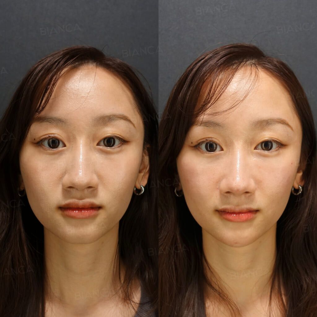 Hyaluronic acid filler before and after Restylane Lyft at the nose tip, alar base and chin, front view immediately after treatment