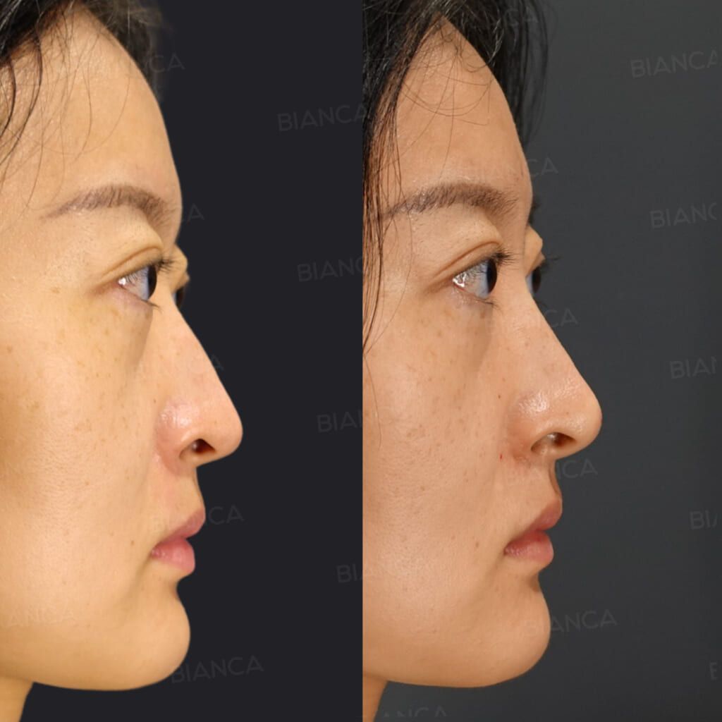 Hyaluronic acid filler before and after Restylane Lyft at the nose tip refining projection and the nasolabial angle, side view immediately after treatment